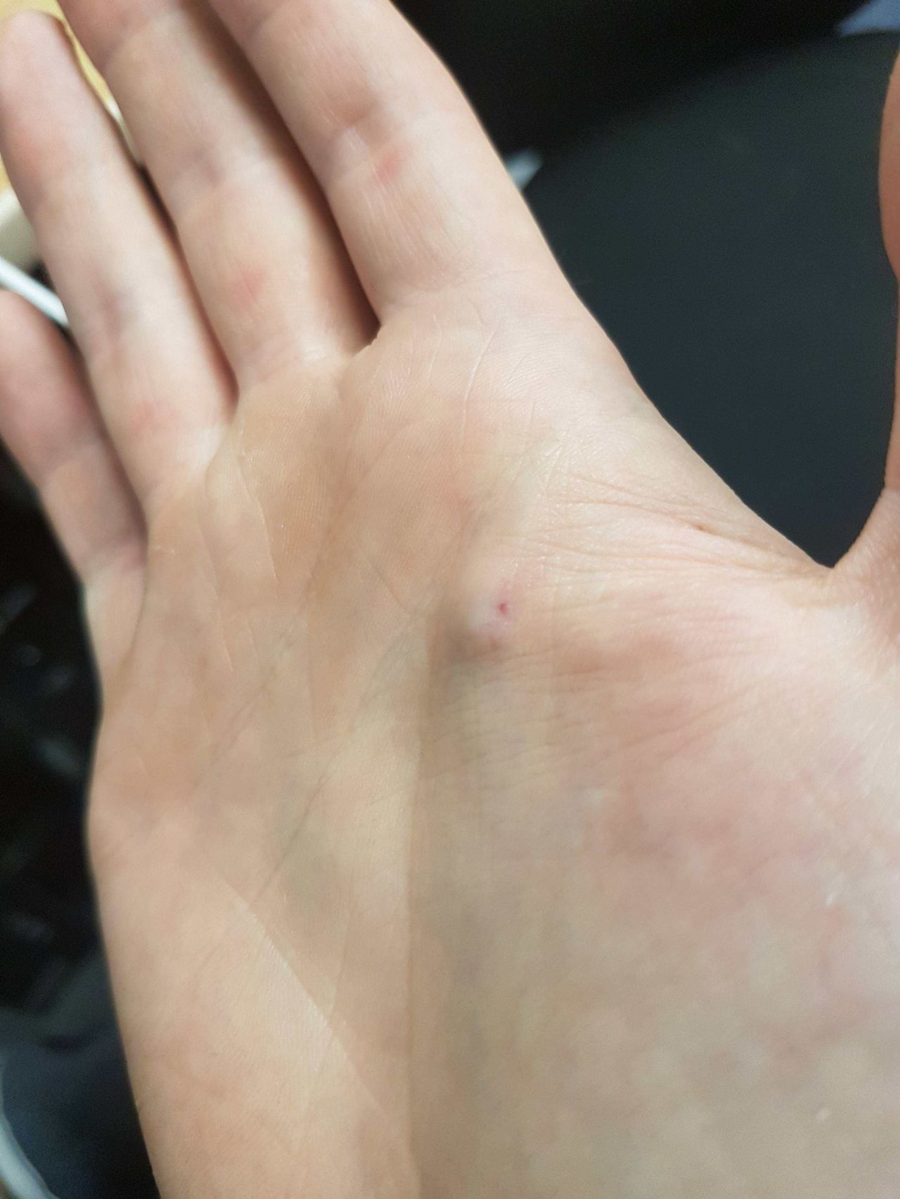 'Nintendo Switch me ayudó a detectar un tumor a tiempo en la mano'