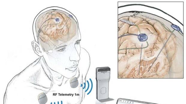 Registro de la actividad cerebral de los seres humanos a distancia