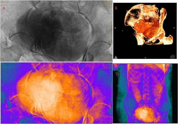 Radiograf�as y tomograf�as computarizadas del abdomen de la momia, que revelan al feto