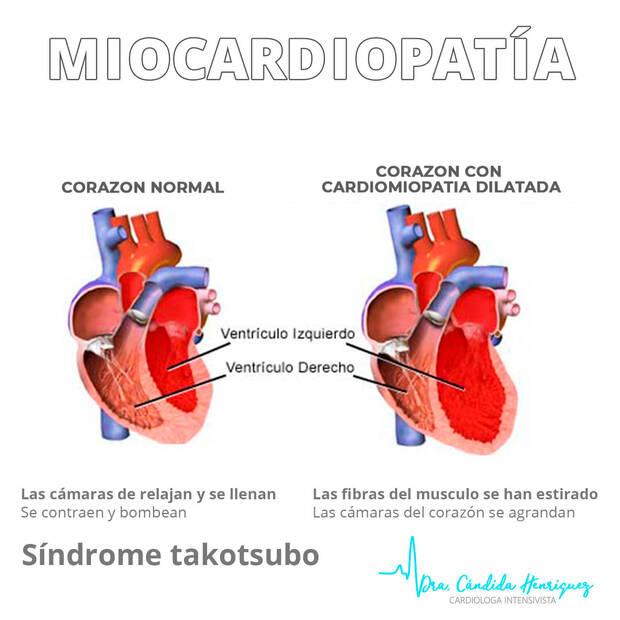 ¿Qué es la miocardiopatía de Takotsubo?
